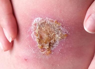 همه چیز درباره زخم عفونی + روش های درمان