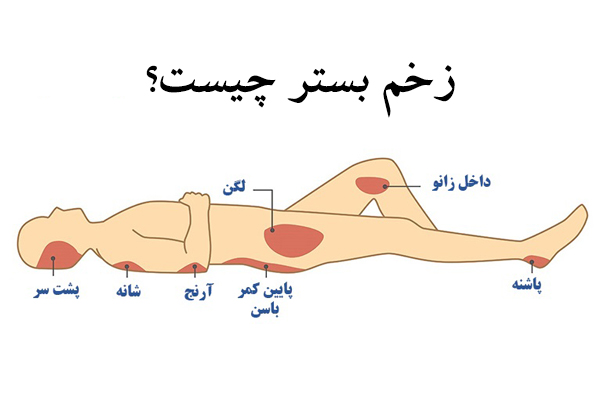 زخم بستر چیست؟